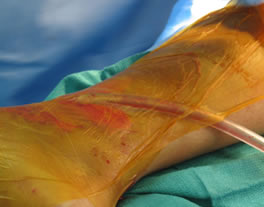 Wound