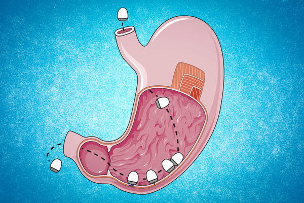 illustration of a oral capsule passing through the stomach