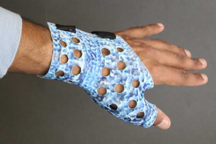 A person’s arm wearing a 3D-printed wrist-protecting cast that is textured, blue, and has holes.