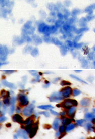 Immunohistochemical detection of tumor-specific antigens in breast cancer tissue. Targeting these differences is the basis for engineered cancer vaccines.