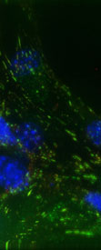 Breast carcinoma cells in 3D-culture highlighting the role of actomysin in cell adhesion.
