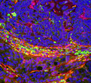 Immunoflourescent staining of breast cancer tissue suggests that SMA-positive cells are recruited from the bone marrow and adjacent tissue.