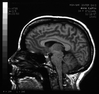 MRI picture of Anne's brain