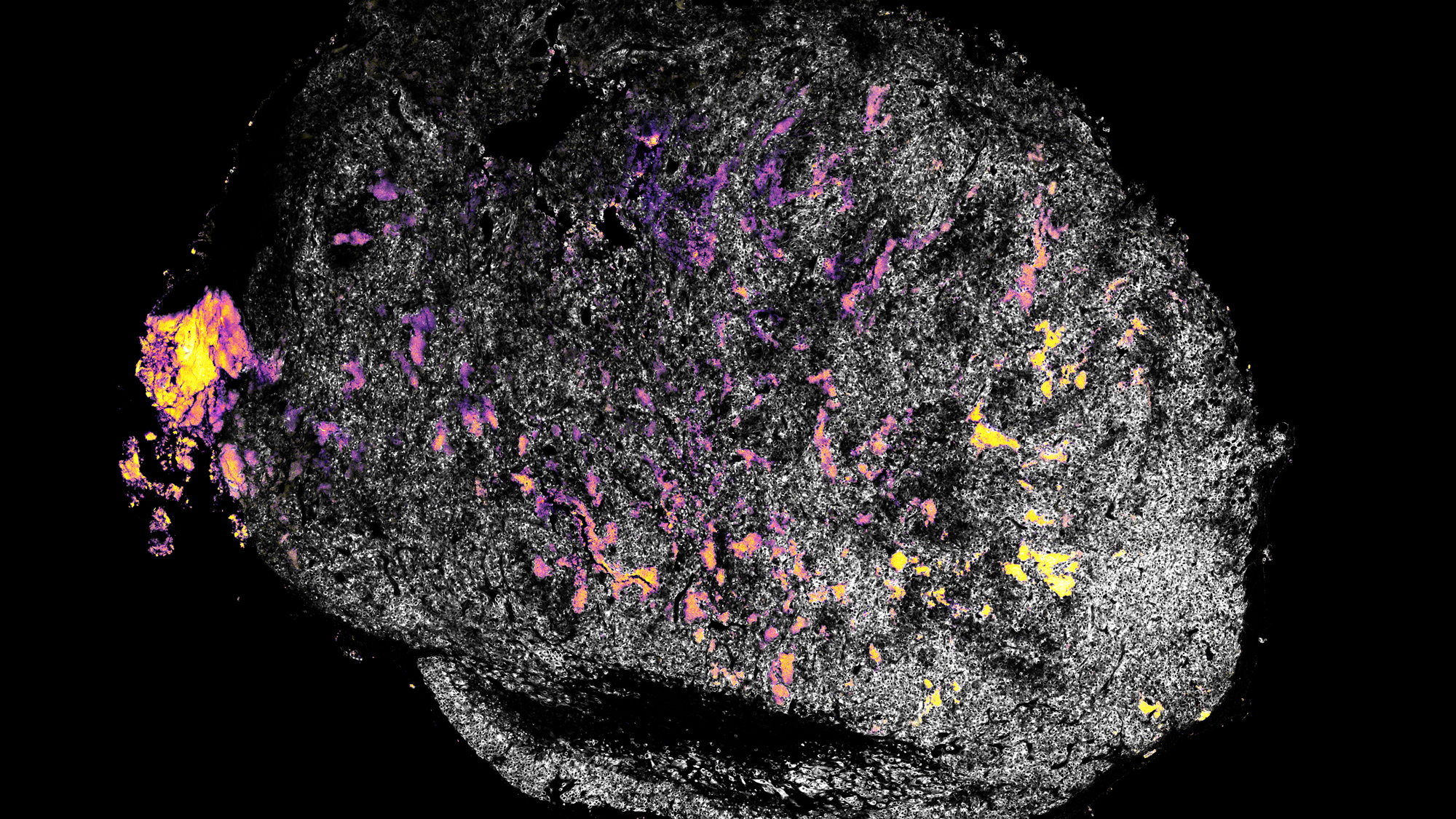 This image depicts a tumor right after treatment with alum-bound IL12, shown in yellow and pink