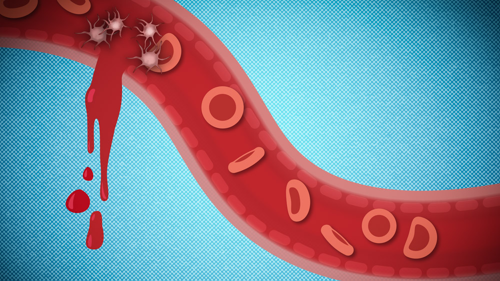 Illustration shows a vein with red blood cells with a rupture over blue background