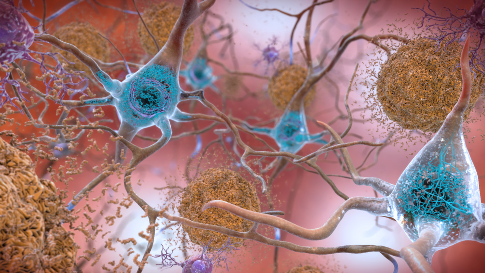 neurons affected by plaques that accumulate with Alzheimer’s