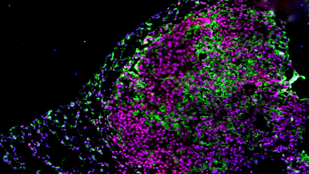 lung tumor cells
